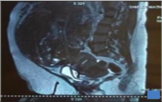 gigantic myoma in abdomen